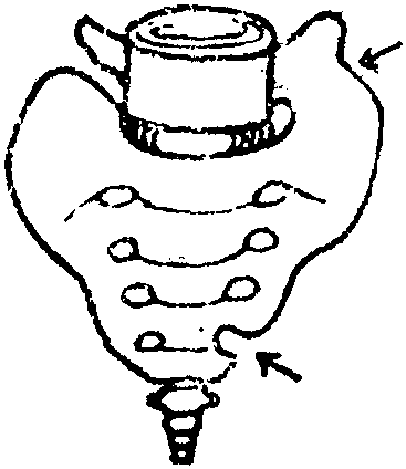 一侧腰椎骶化